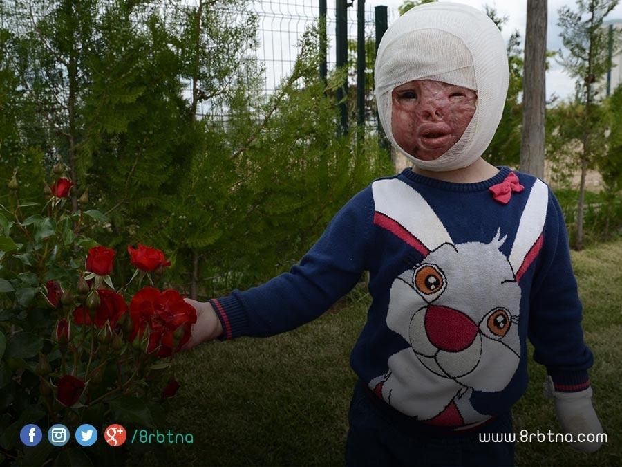 بالصور:تركيا تتولى علاج طفلة سورية احترق وجهها بالكامل بقصف النظام