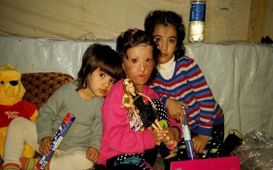 الأمم المتحدة تمنح  بصيص أمل قد يخفف آلام طفلة سورية لاجئة احترق وجهها بالكيروسين 